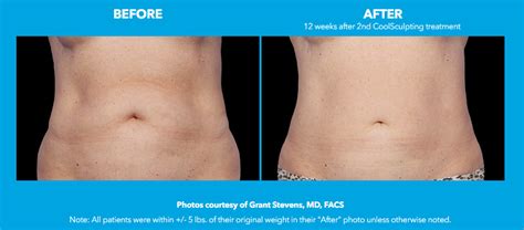 coolsculpting philippines|Things To Know About CoolSculpting .